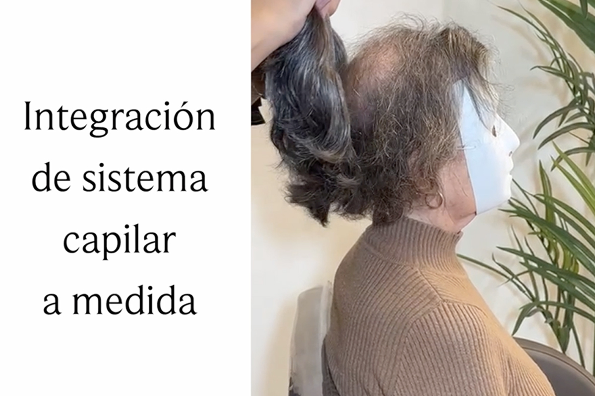 Solución para la Alopecia Areata