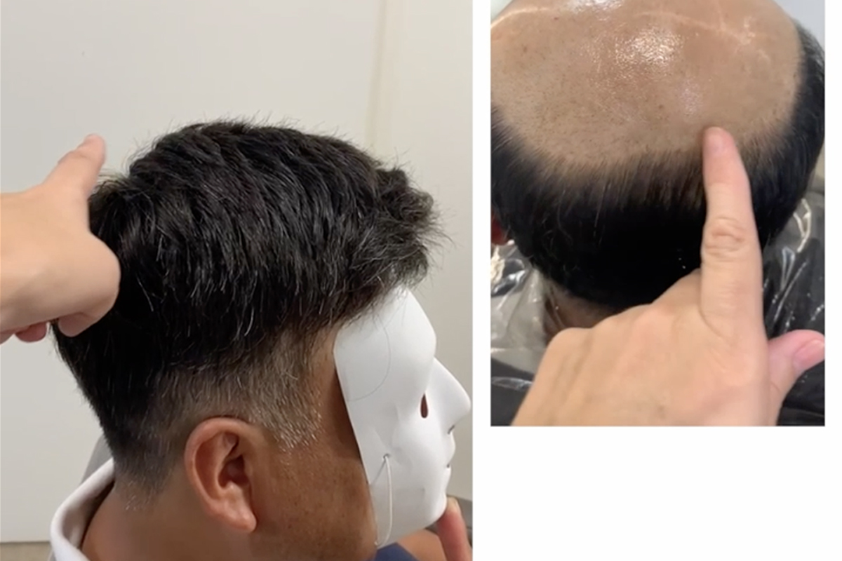 Soluciones para la Alopecia de Hombres