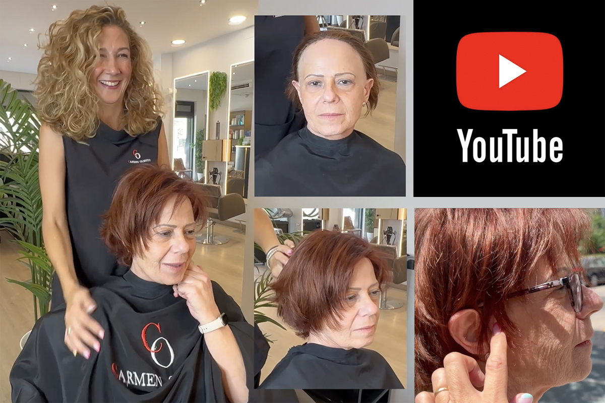 Aro de cabello natural para alopecia frontal fibrosante